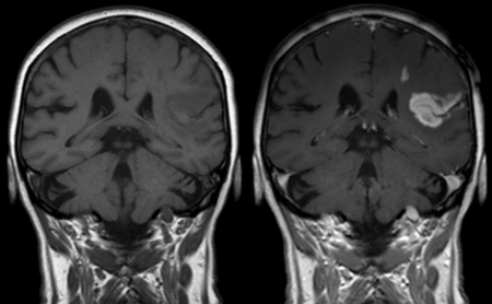Ødelagt blod-hjernebarriere etter hjerneslag, vist på MRI. Foto: Hellerhoff. Kilde: Wikimedia Commons.